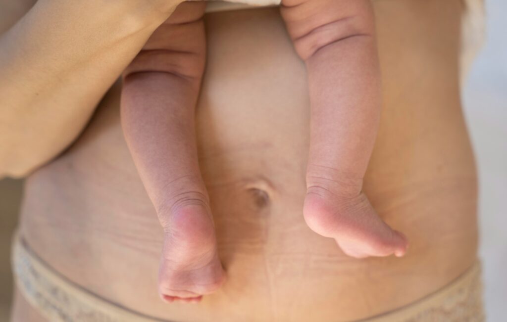 Tummy Tuck during Cesarean Section