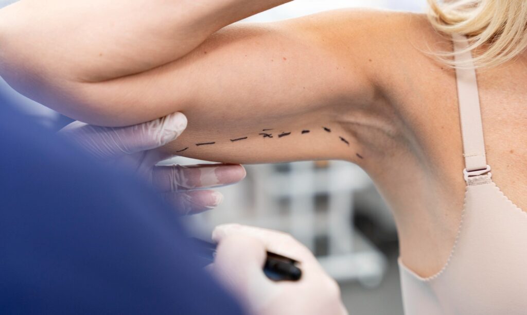 How Much Do You Understand About Arm Lift?