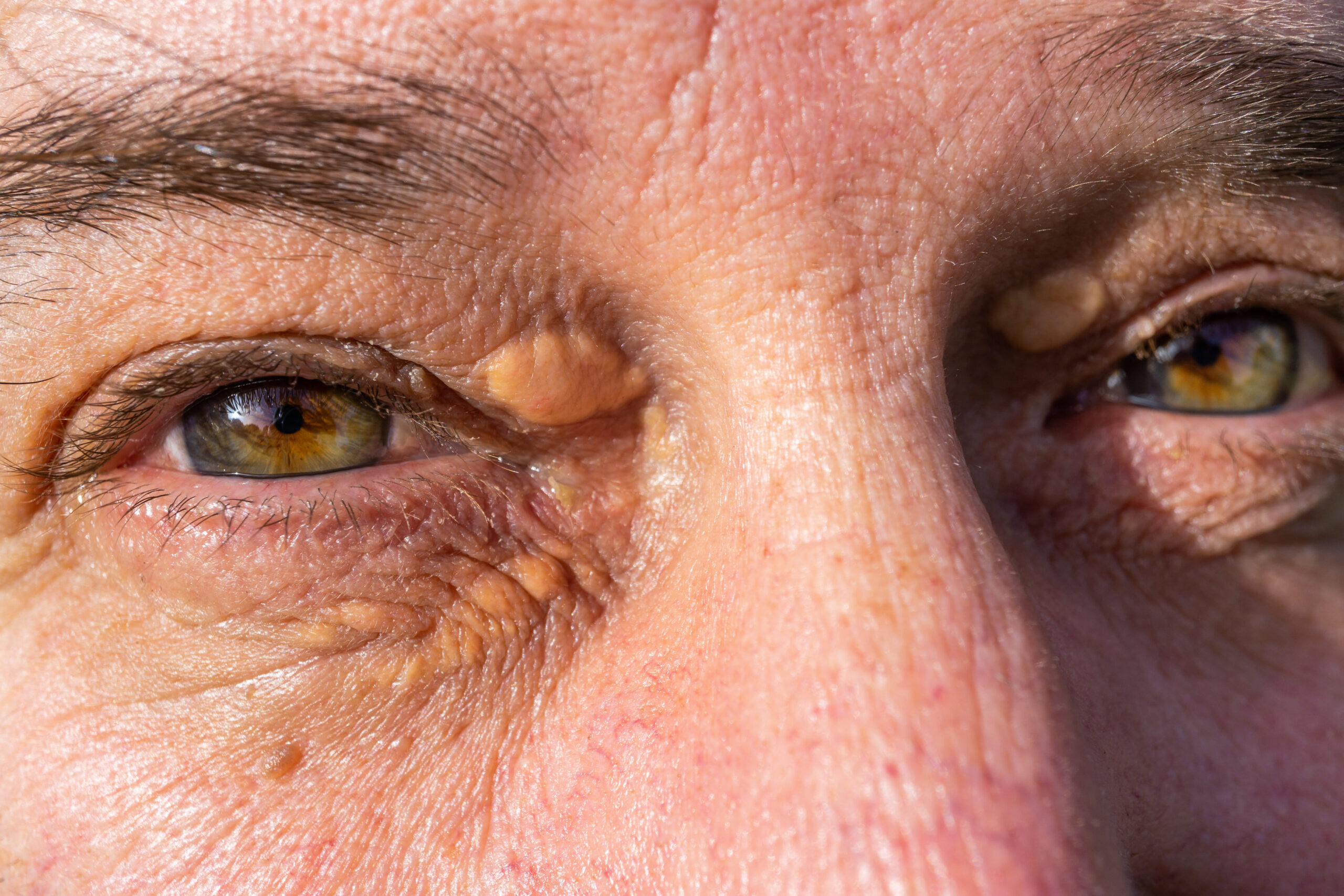 How Much Do You Know  About Xanthelasma?