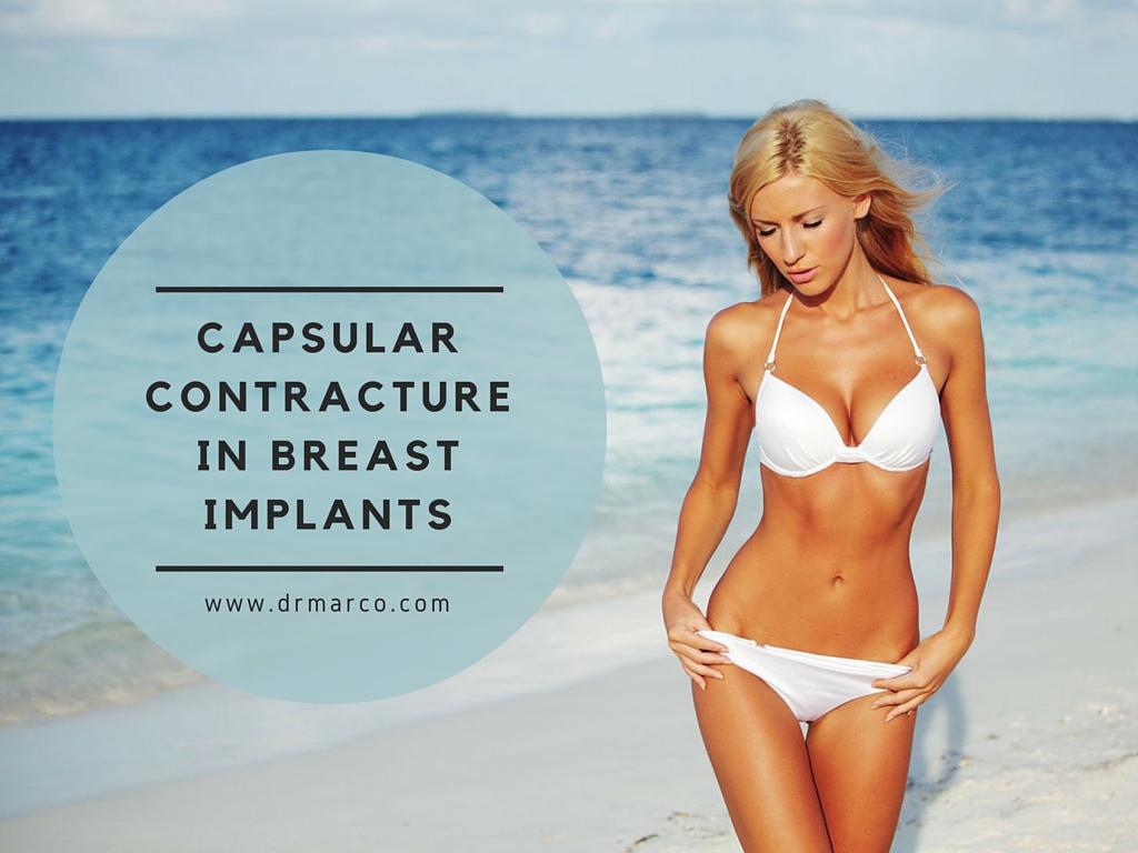 Let’s Talk About Capsular Contracture in Breast Implants
