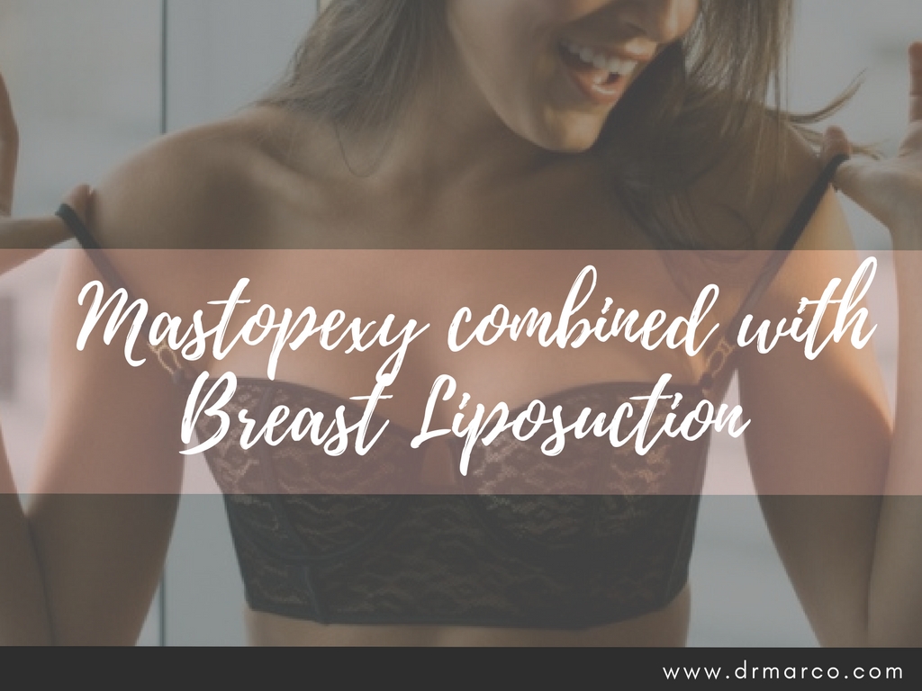 Should Mastopexy be Combined with Breast Liposuction?