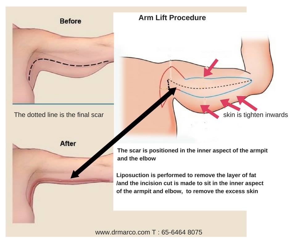 armliftprocedure_drmarcoplasticsurgery2018