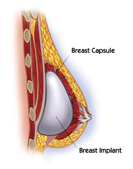 breastcapsule