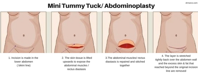 Mini Tummy Tuck - Dr Marco