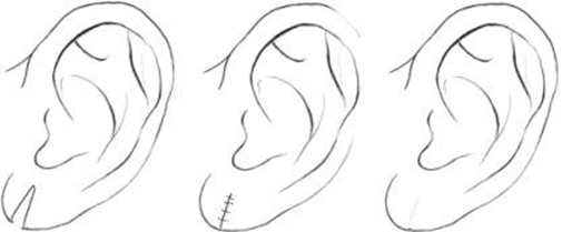 ear lobe repair steps