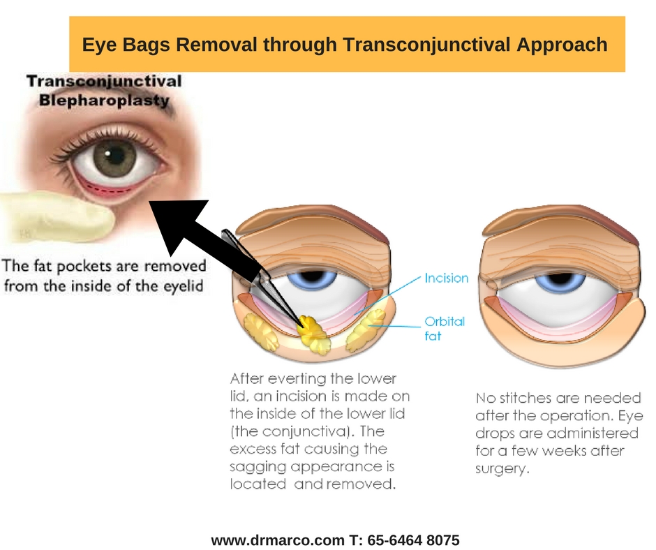 eye bags thru transconjun