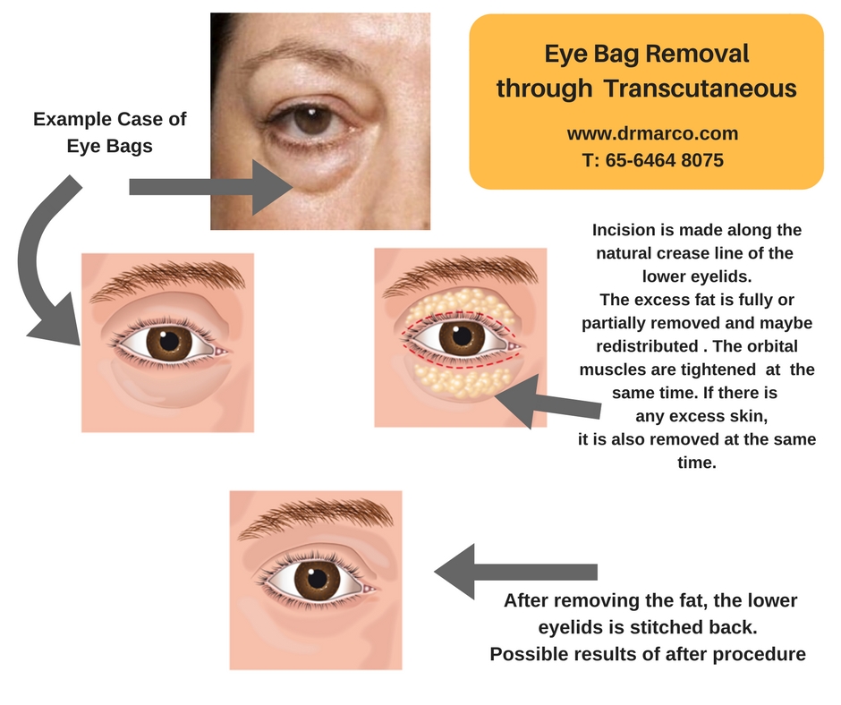 eyebag removal transub_drmarcoplasticsurgery
