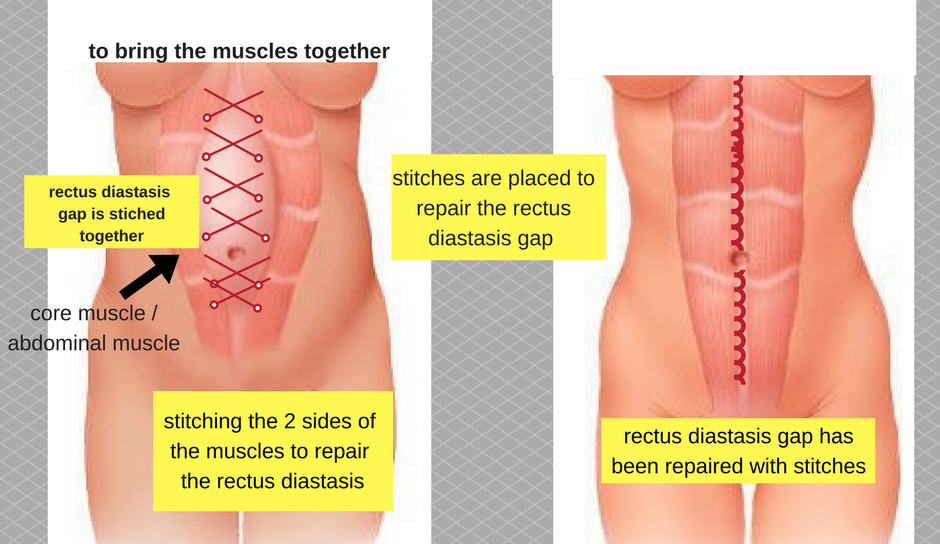 rectus diastasis repair procedure