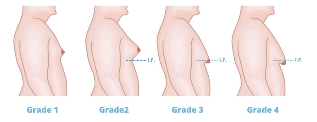 different grades of Gynecomastia