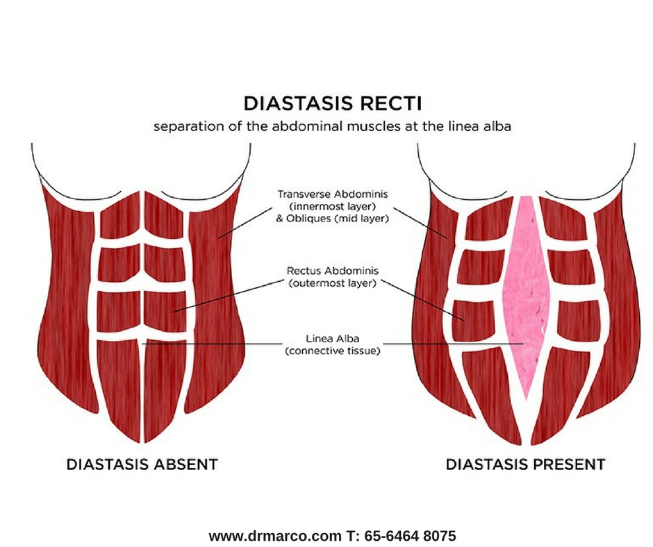 rectus diastasis diagram
