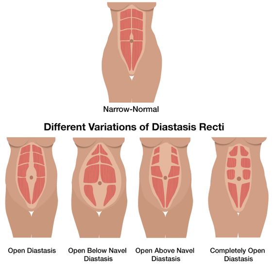 types of rectus diastasis diagram