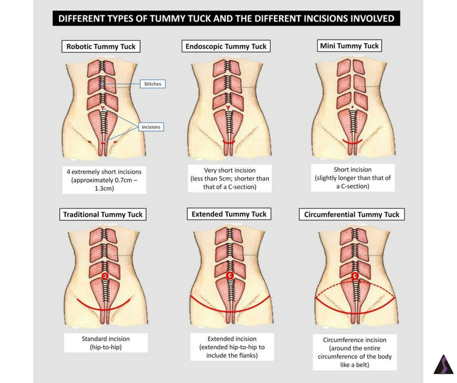 different types of tummy ticks and the incisions involved
