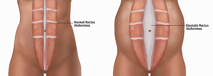 normal abdomen and rectus diastasis diagram