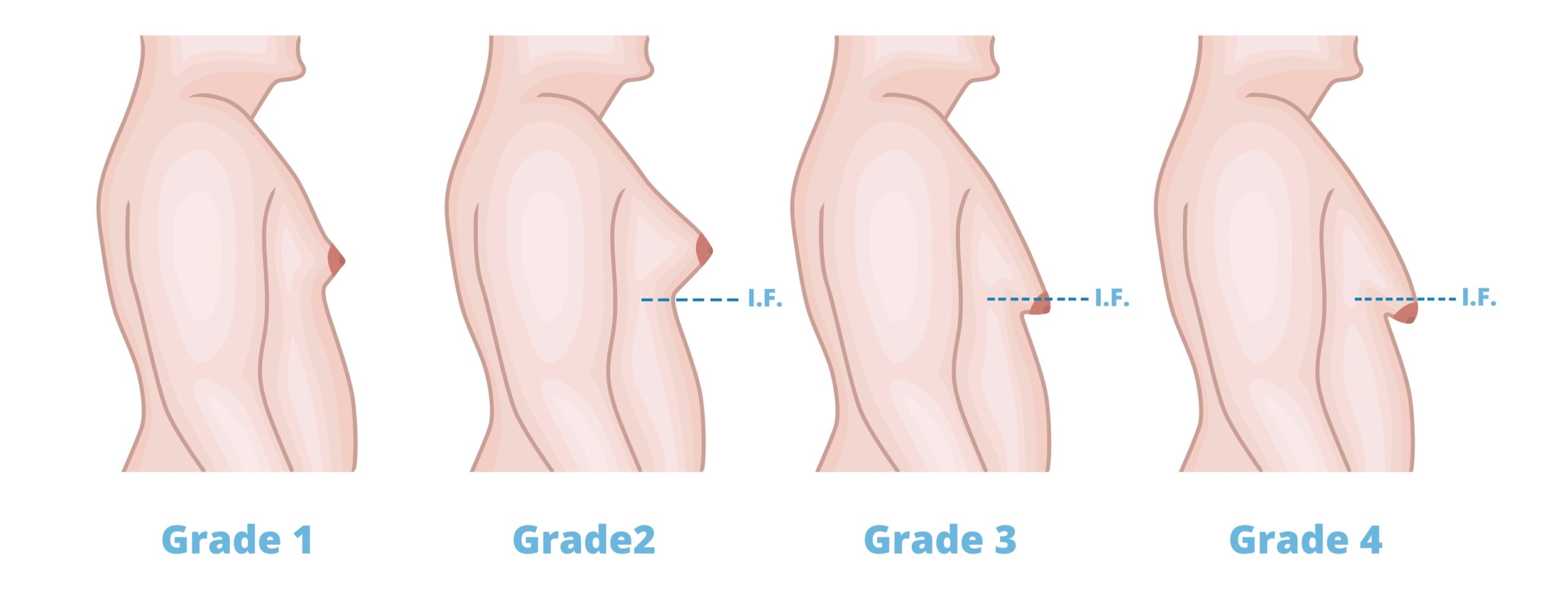 Grades of gynecomastia