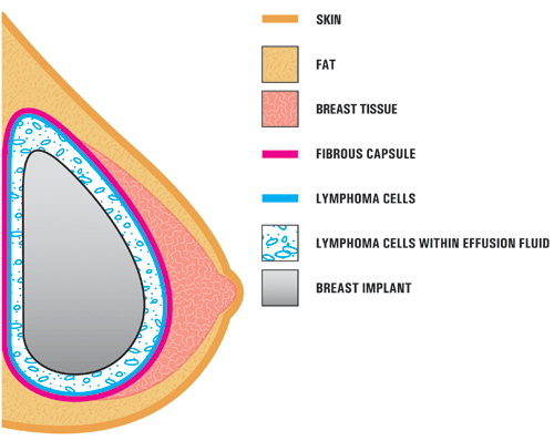Breast Implants in Breasts