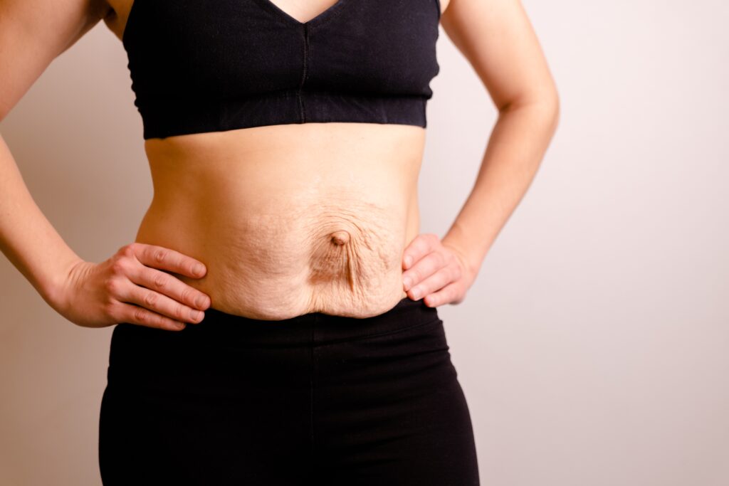 Symptoms of Rectus Diastasis