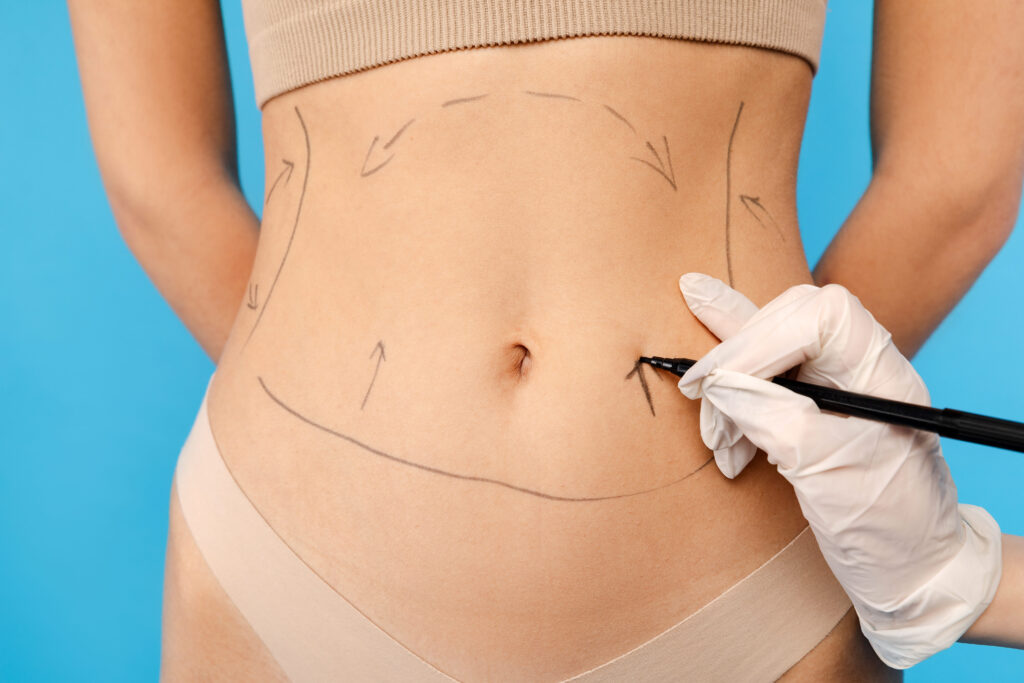 Recovery Timeline After Liposuction