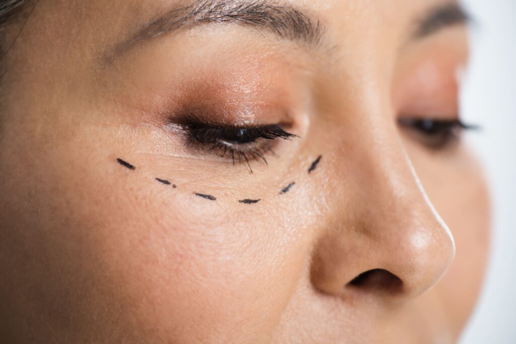 Blepharoplasty Cost in Singapore: What You Need to Know