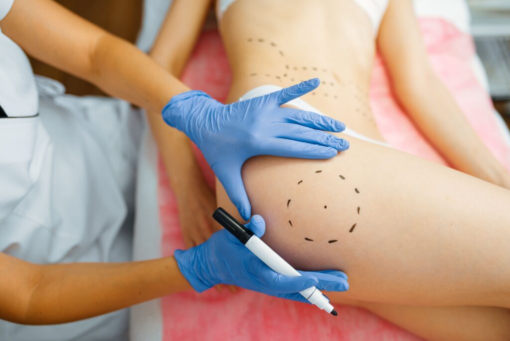 Thigh Liposuction: What You Need to Know