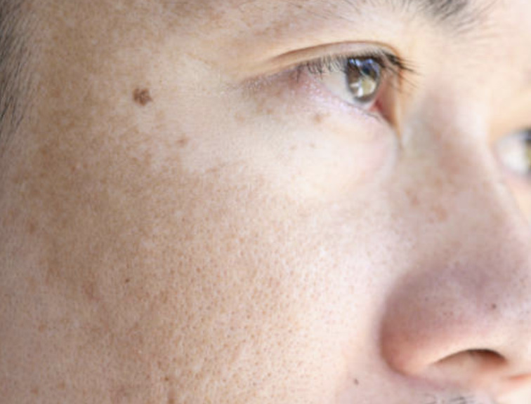 Everything You Need To Know About Skin Melasma And Its Treatment